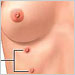 supernumerary-nipples